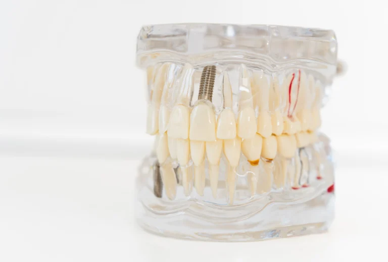 Model zubného implantátu s korunkou